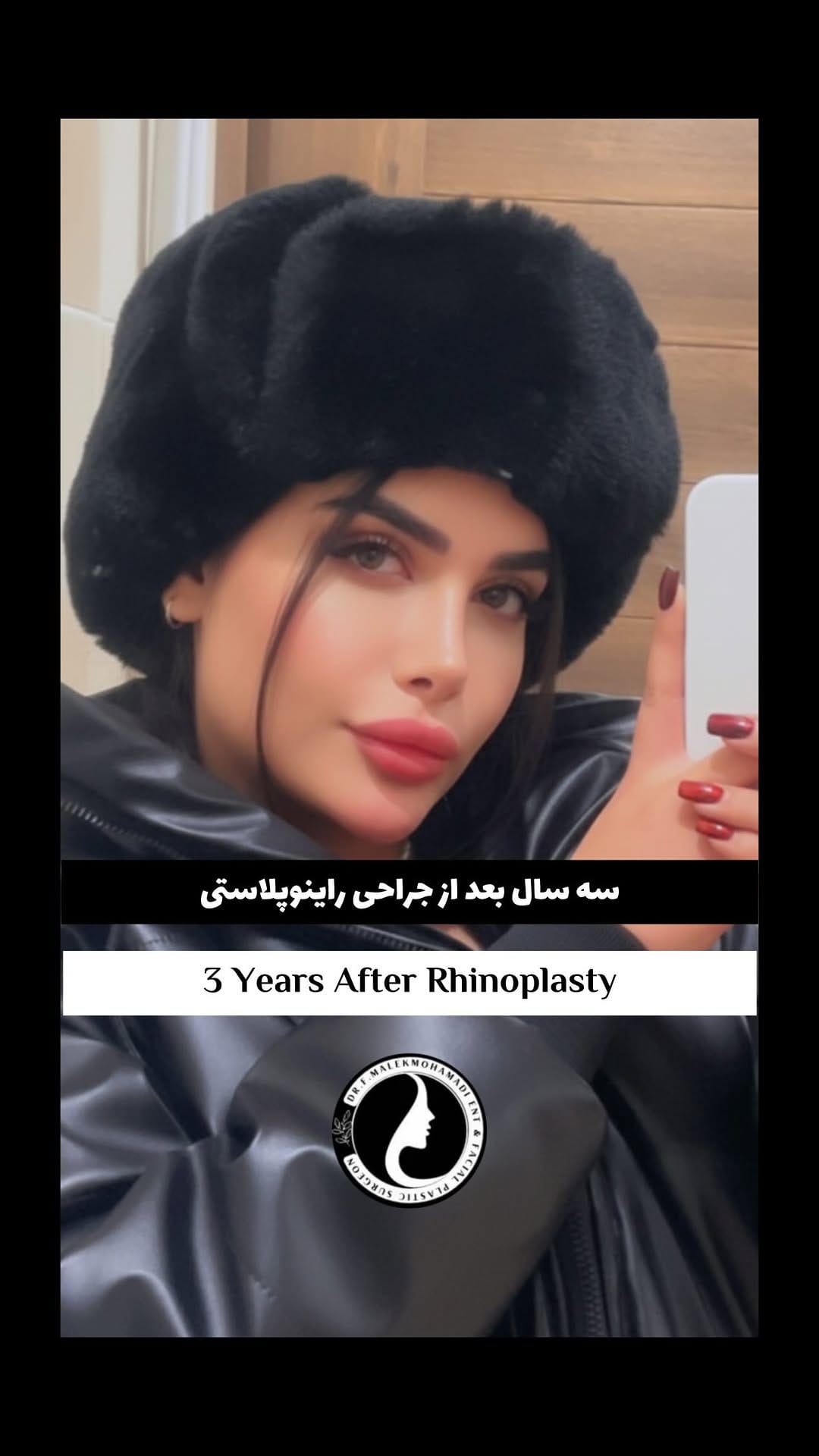 Post 2 by دکتر فریبا ملک محمدی | جراح بینی و صورت on Instagram (video)