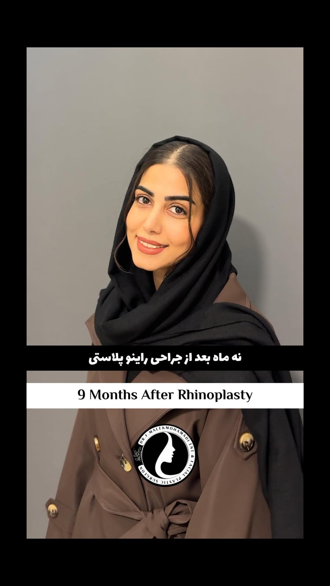 Post 6 by دکتر فریبا ملک محمدی | جراح بینی و صورت on Instagram (video)