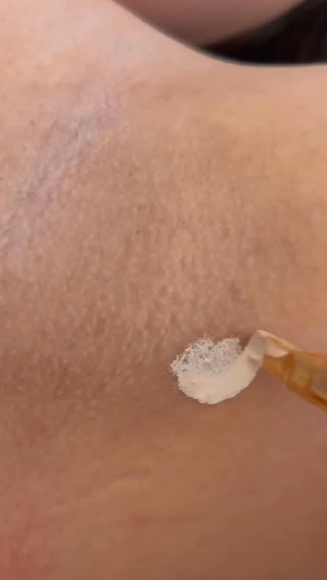 Post 10 by Uzm. Cansu Kayaarslan/Çatlak İzi/Ameliyat İzi/Vitiligo on Instagram (video)