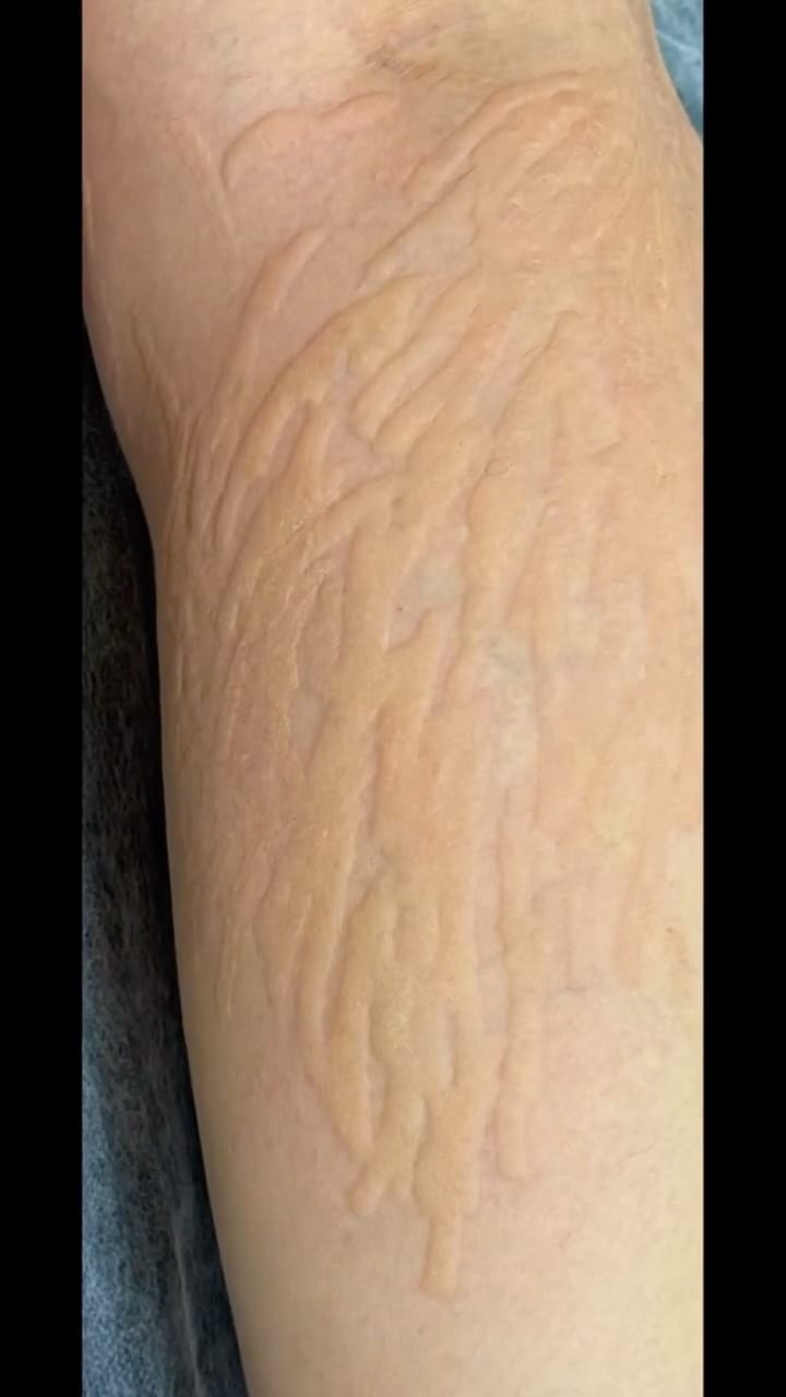 Post 1 by Uzm. Cansu Kayaarslan/Çatlak İzi/Ameliyat İzi/Vitiligo on Instagram (video)