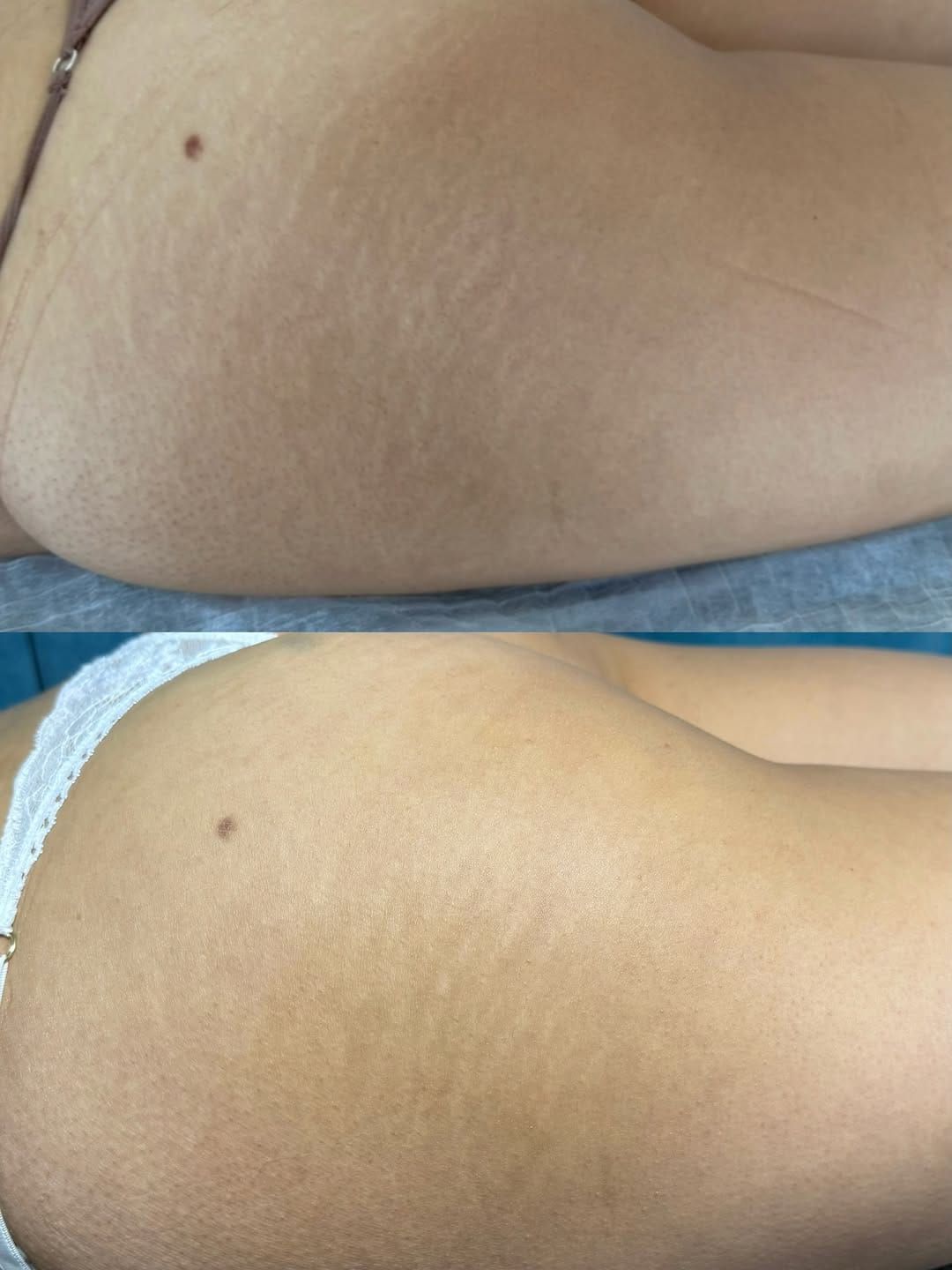 Post 3 by Uzm. Cansu Kayaarslan/Çatlak İzi/Ameliyat İzi/Vitiligo on Instagram (image)
