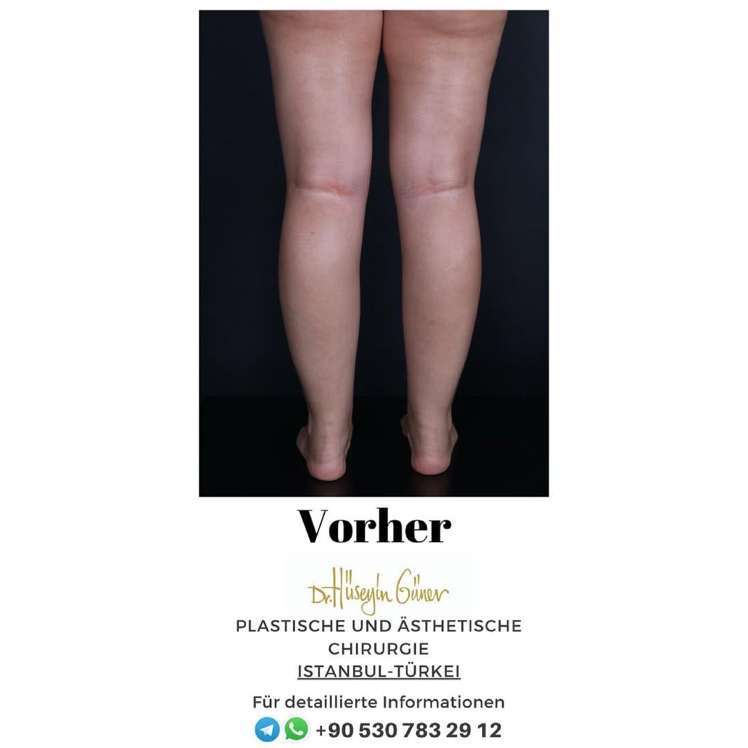 Post 10 by Dr. Hüseyin Güner Klinik on Instagram (carousel)