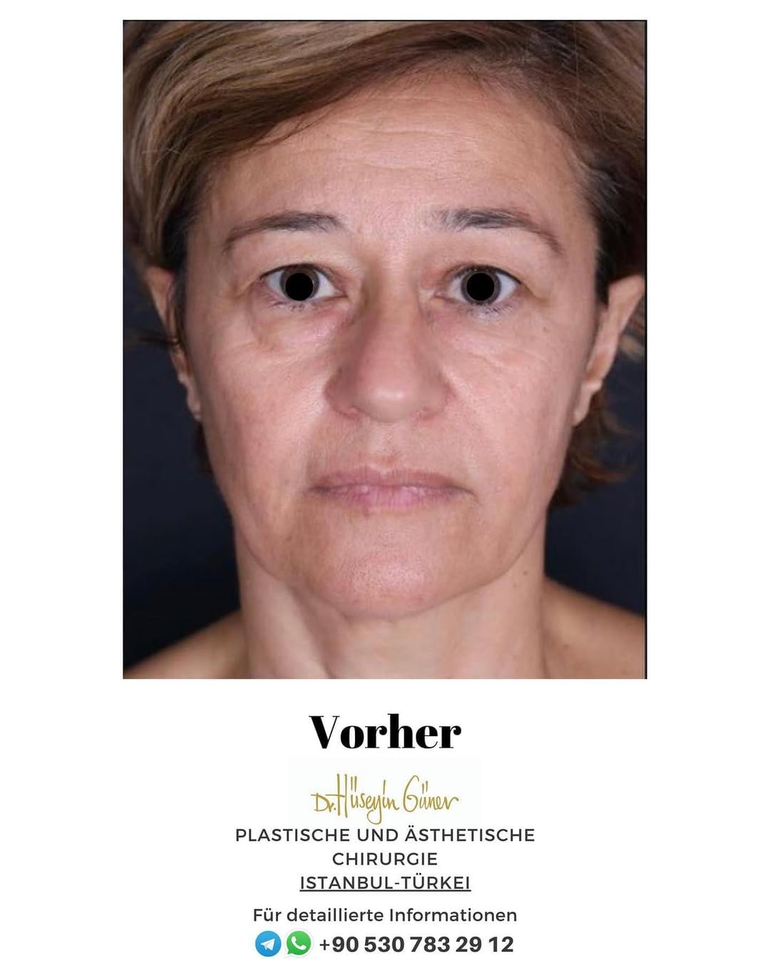 Post 1 by Dr. Hüseyin Güner Klinik on Instagram (carousel)