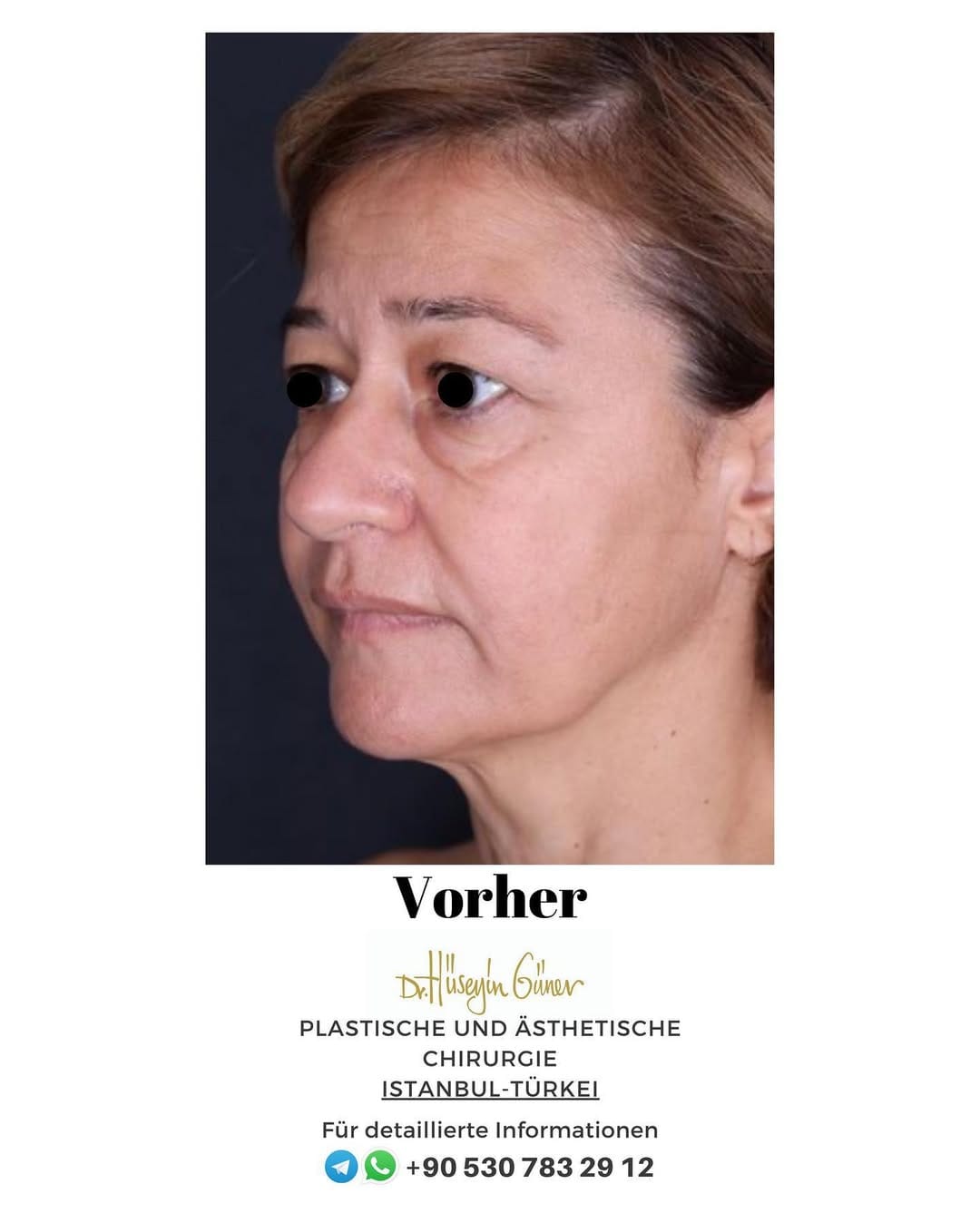 Post 5 by Dr. Hüseyin Güner Klinik on Instagram (carousel)