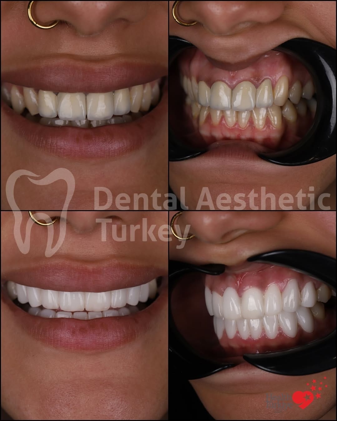 Post 5 by Dental Aesthetic Turkey on Instagram (carousel)