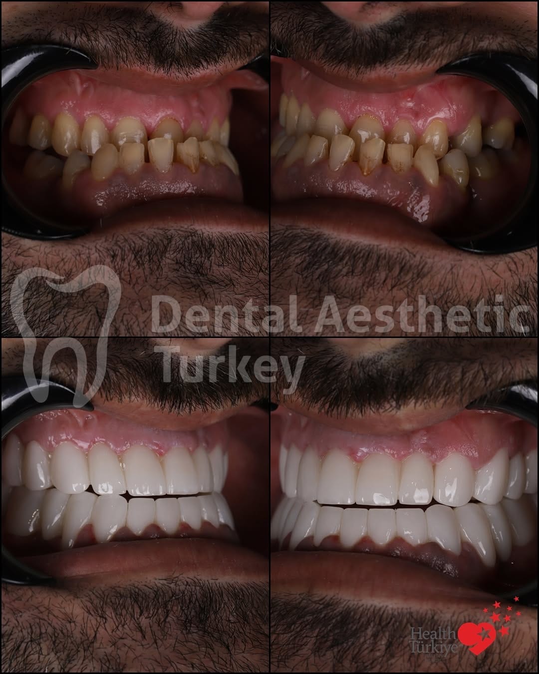 Post 3 by Dental Aesthetic Turkey on Instagram (carousel)