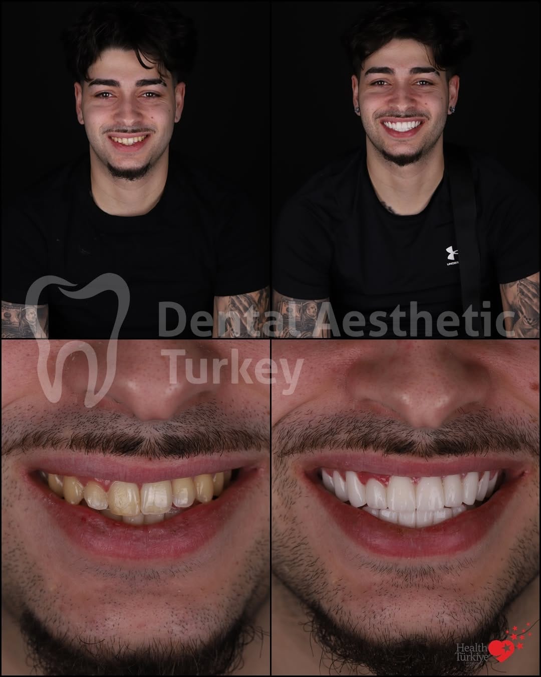 Post 6 by Dental Aesthetic Turkey on Instagram (carousel)
