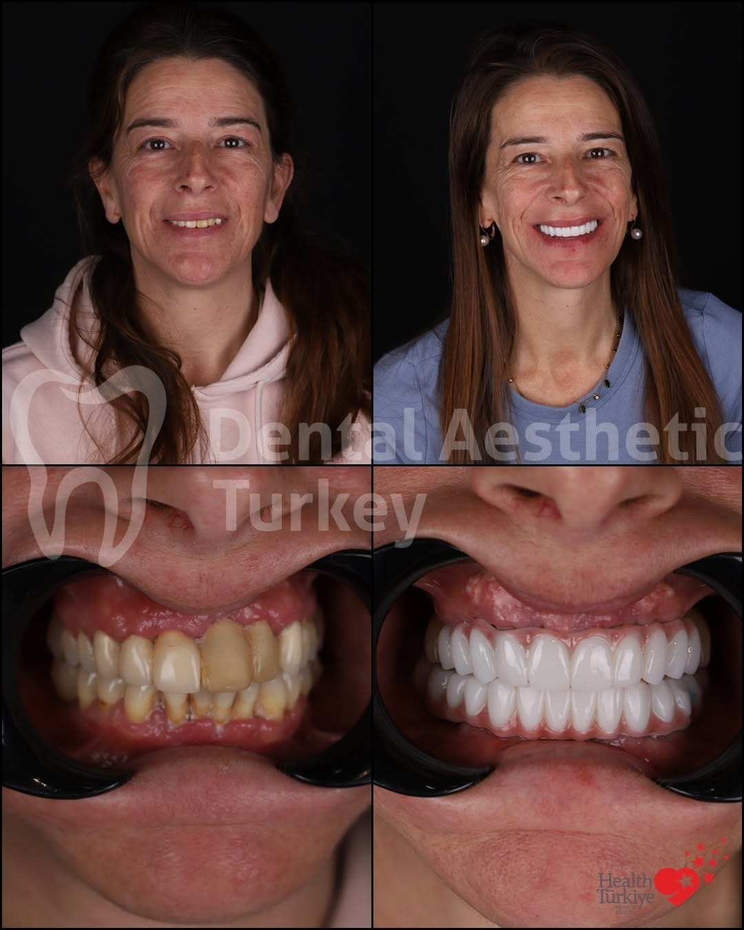 Post 4 by Dental Aesthetic Turkey on Instagram (carousel)