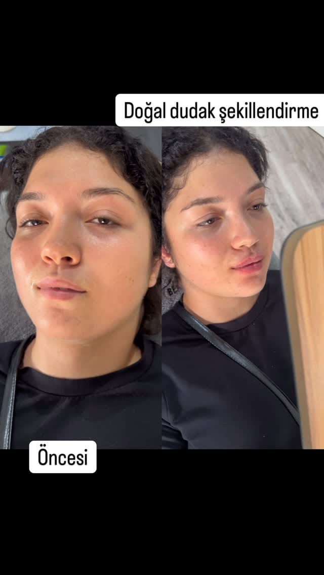 Post 8 by Aydan Gümüş Estetik ve Güzellik Salonu on Instagram (video)