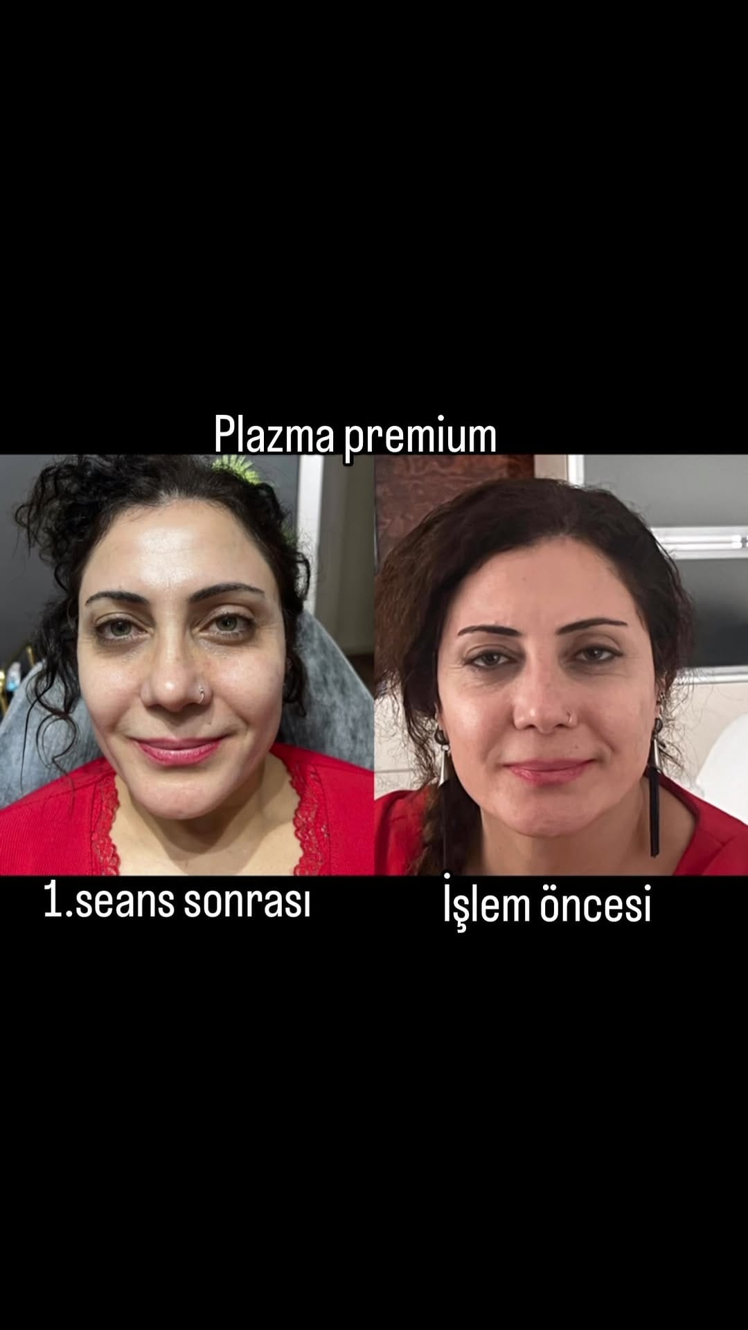 Post 10 by Aydan Gümüş Estetik ve Güzellik Salonu on Instagram (video)