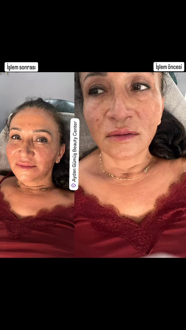 Post 7 by Aydan Gümüş Estetik ve Güzellik Salonu on Instagram (video)