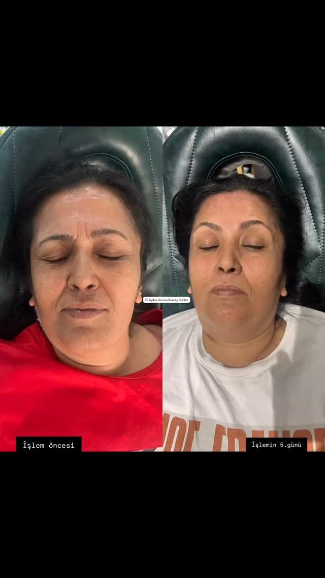 Post 3 by Aydan Gümüş Estetik ve Güzellik Salonu on Instagram (video)