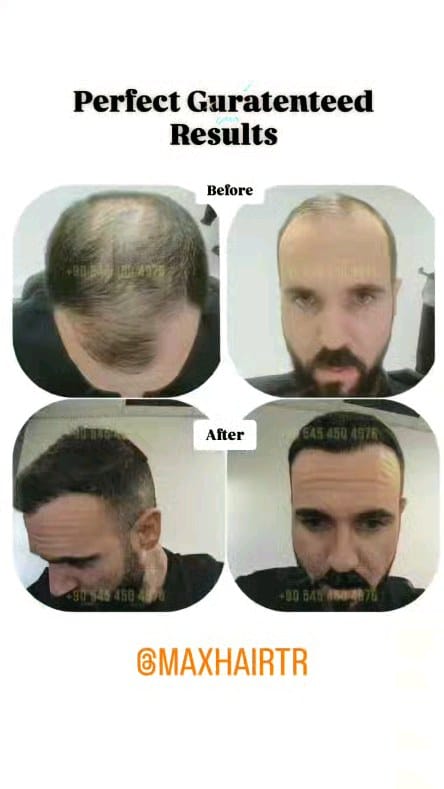 Post 2 by Max Hair Trans on Instagram (video)