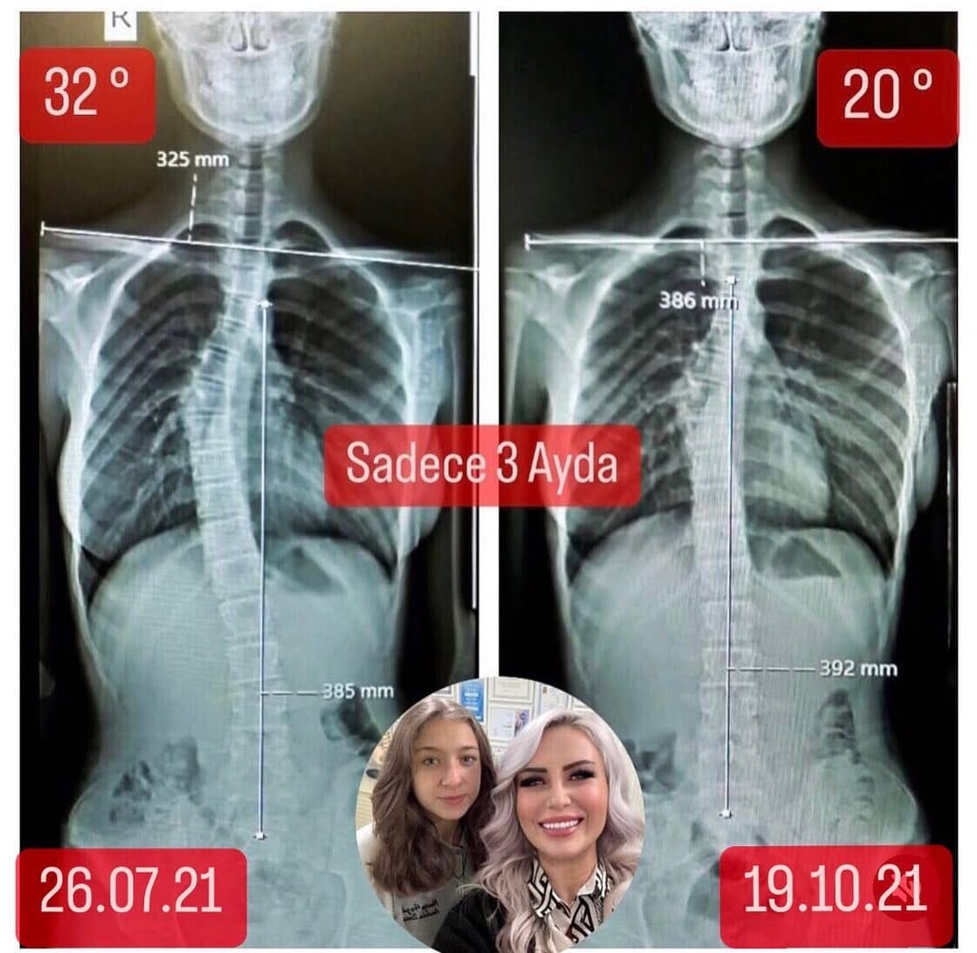 Post 9 by Elif Akıncı Omurga Merkezi on Instagram (carousel)