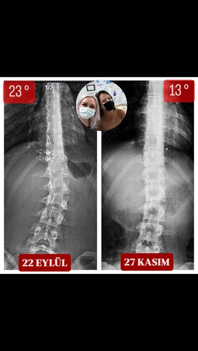 Post 7 by Elif Akıncı Omurga Merkezi on Instagram (video)