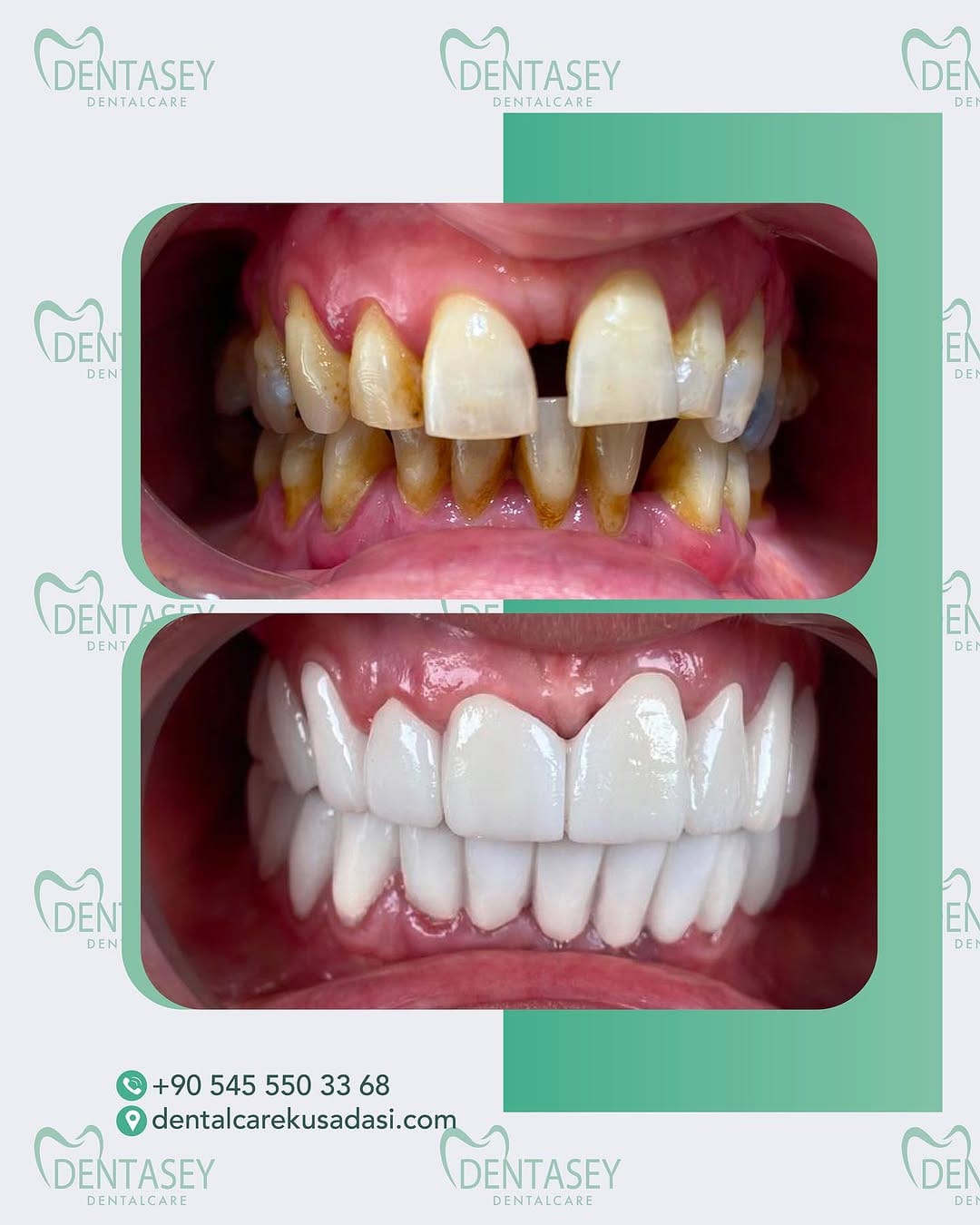 Post 6 by Dentasey Dental Care Kusadasi on Instagram (image)