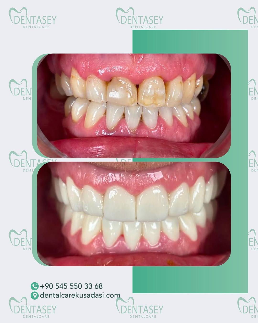 Post 9 by Dentasey Dental Care Kusadasi on Instagram (image)