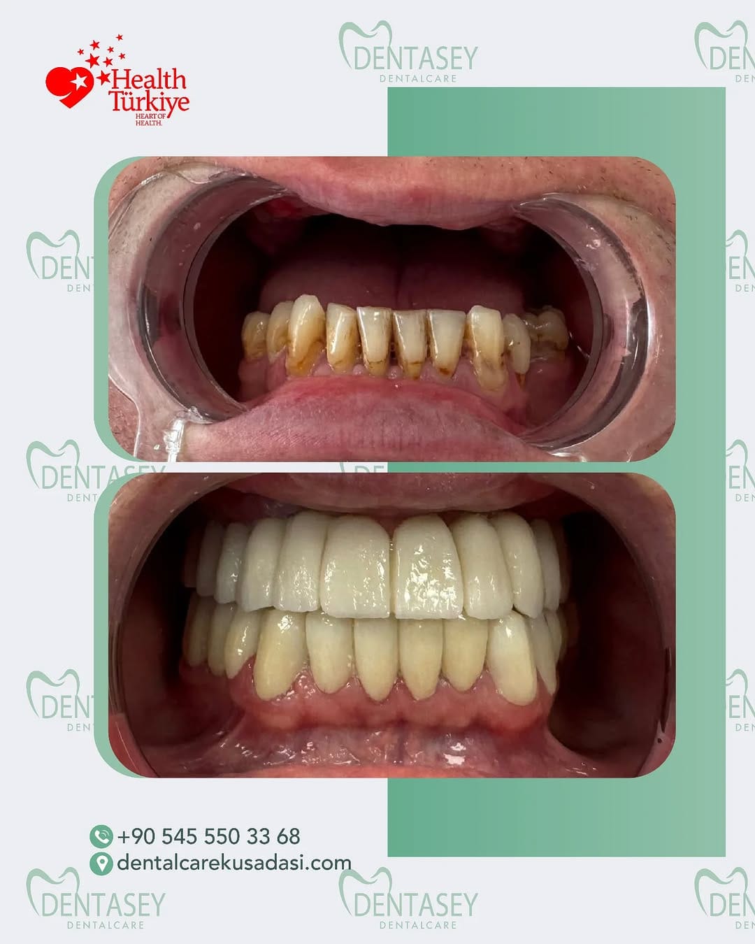 Post 3 by Dentasey Dental Care Kusadasi on Instagram (image)