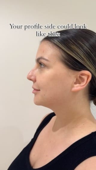 Post 9 by COSMETOLOGY DUBAI| LIPS | BOTOX | NOSE FILLER CORRECTION on Instagram (video)