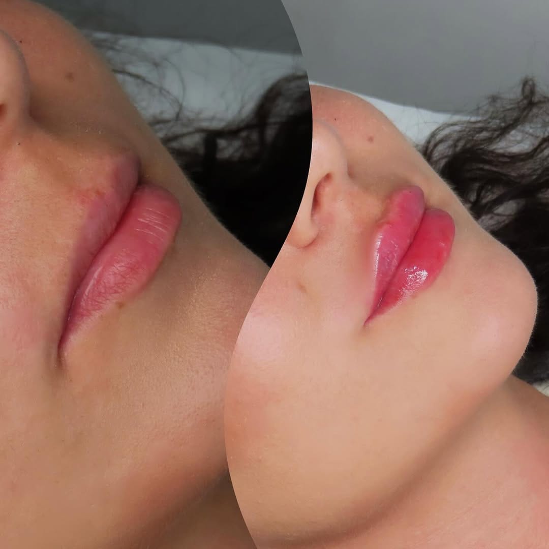 Post 4 by COSMETOLOGY DUBAI| LIPS | BOTOX | NOSE FILLER CORRECTION on Instagram (image)