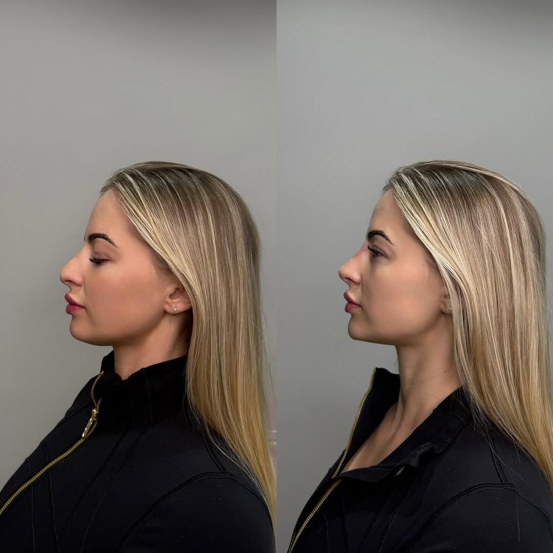Post 2 by COSMETOLOGY DUBAI| LIPS | BOTOX | NOSE FILLER CORRECTION on Instagram (image)