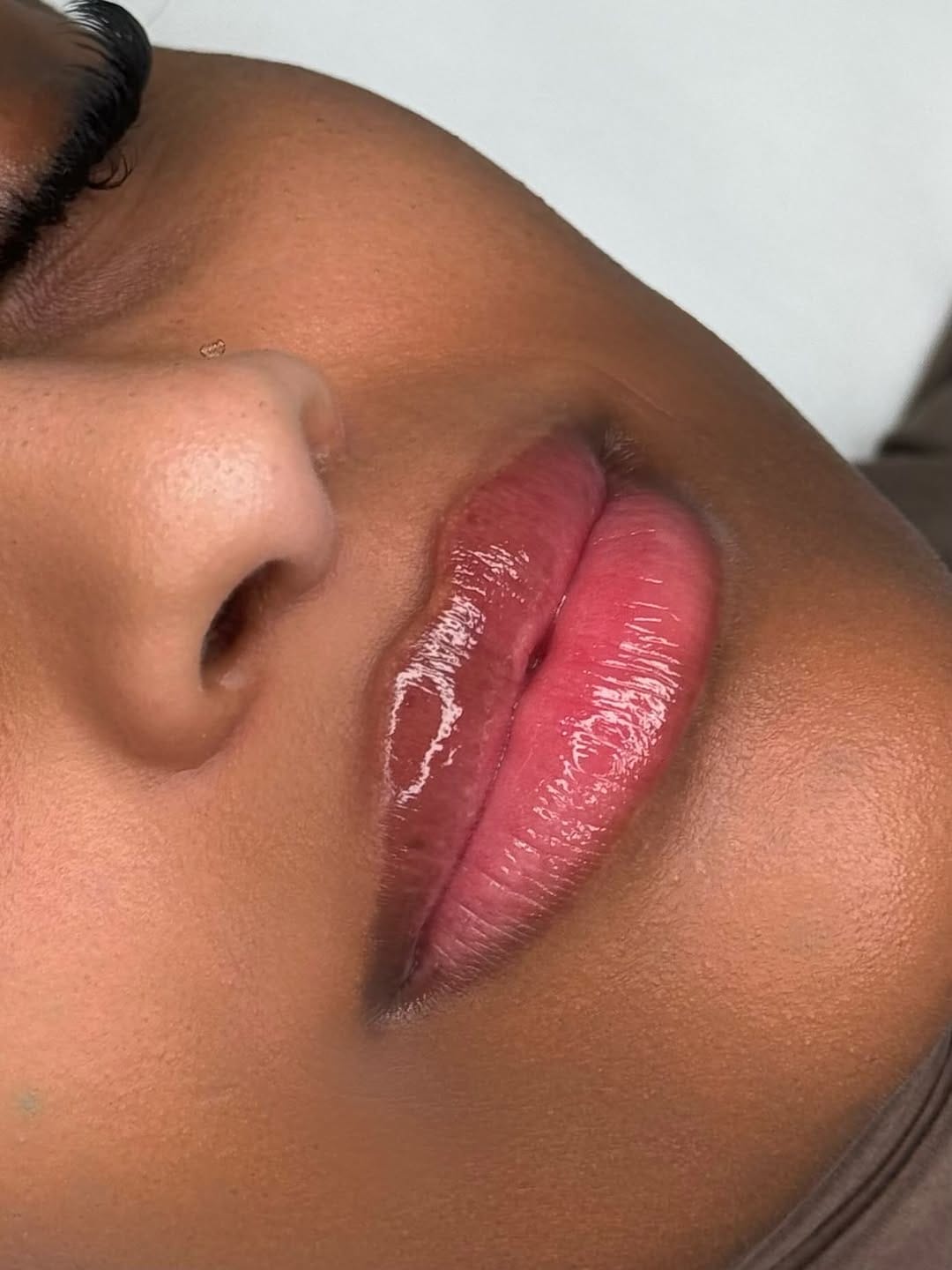 Post 3 by COSMETOLOGY DUBAI| LIPS | BOTOX | NOSE FILLER CORRECTION on Instagram (carousel)