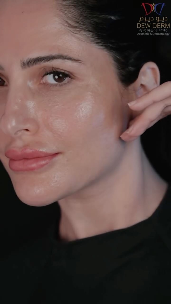 Post 2 by DewDerm on Instagram (video)