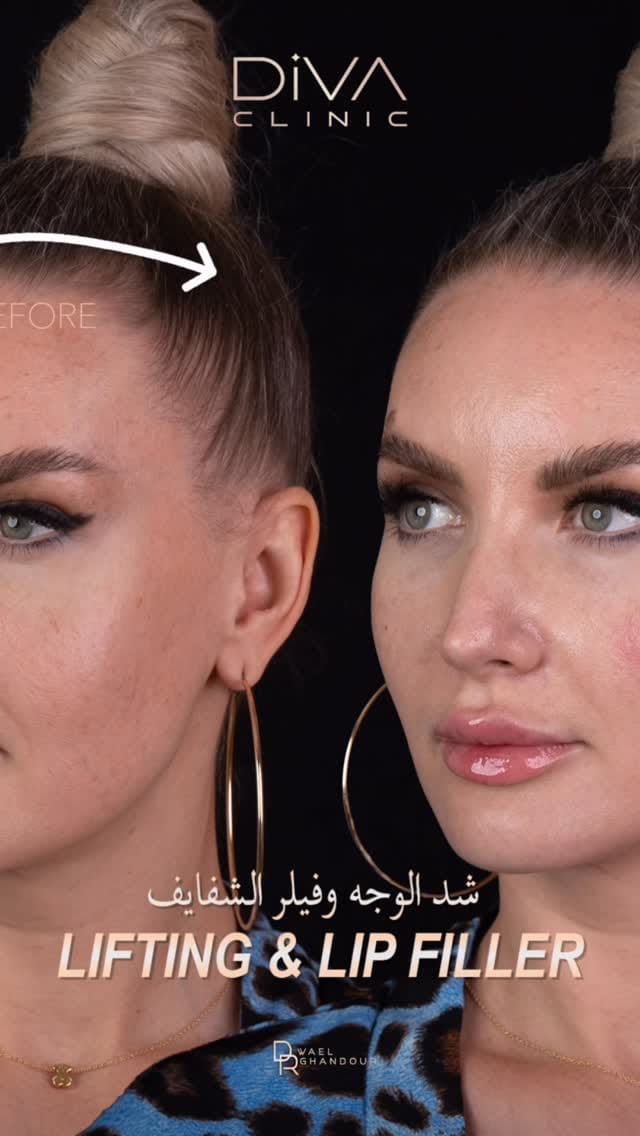 Post 6 by Diva Clinic on Instagram (video)
