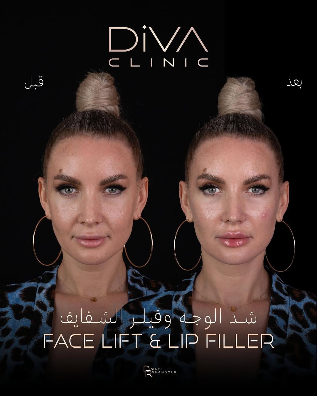 Post 5 by Diva Clinic on Instagram (carousel)