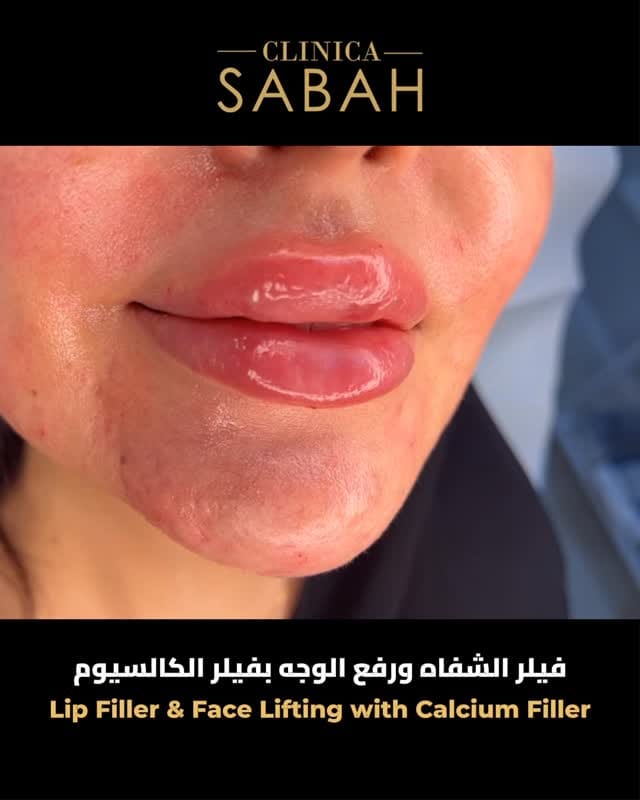 Post 1 by Clinicasabah I كلينيكا صباح on Instagram (video)