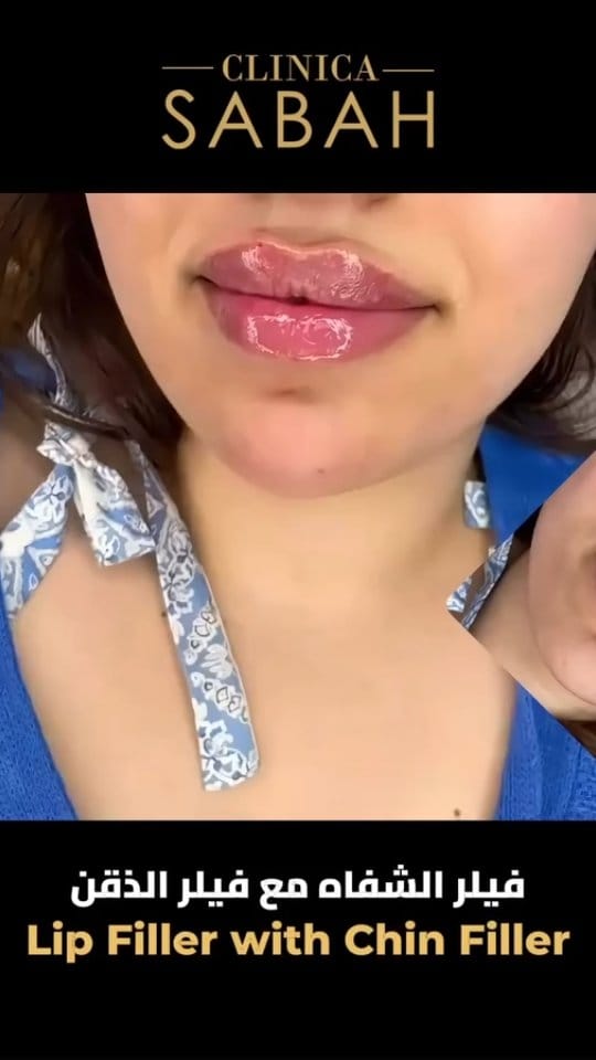 Post 2 by Clinicasabah I كلينيكا صباح on Instagram (video)