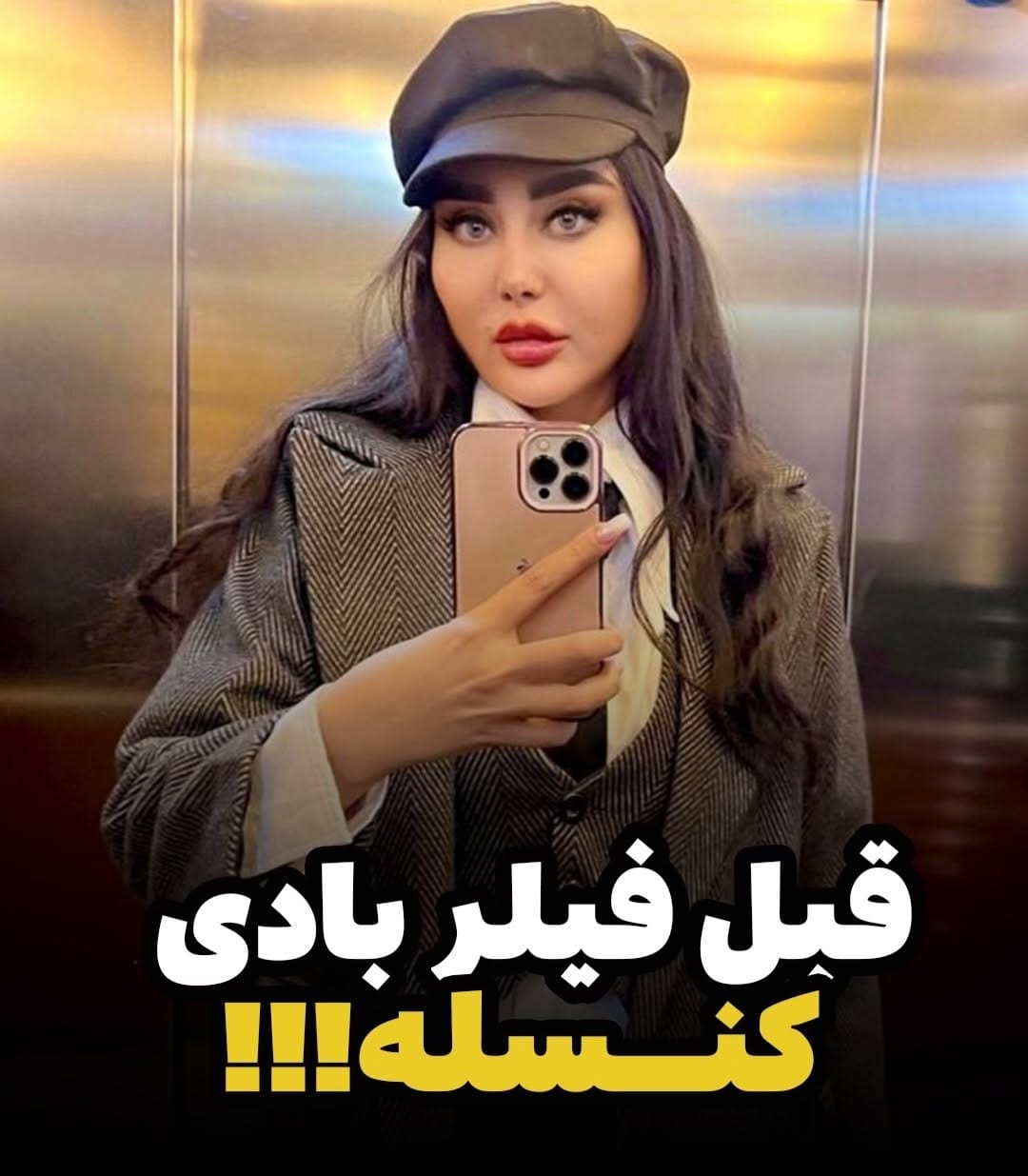 Post 6 by فيلر بادى/ژل لب كانتورينگ/بوتاكس/اندوليفت/جوانساز on Instagram (carousel)