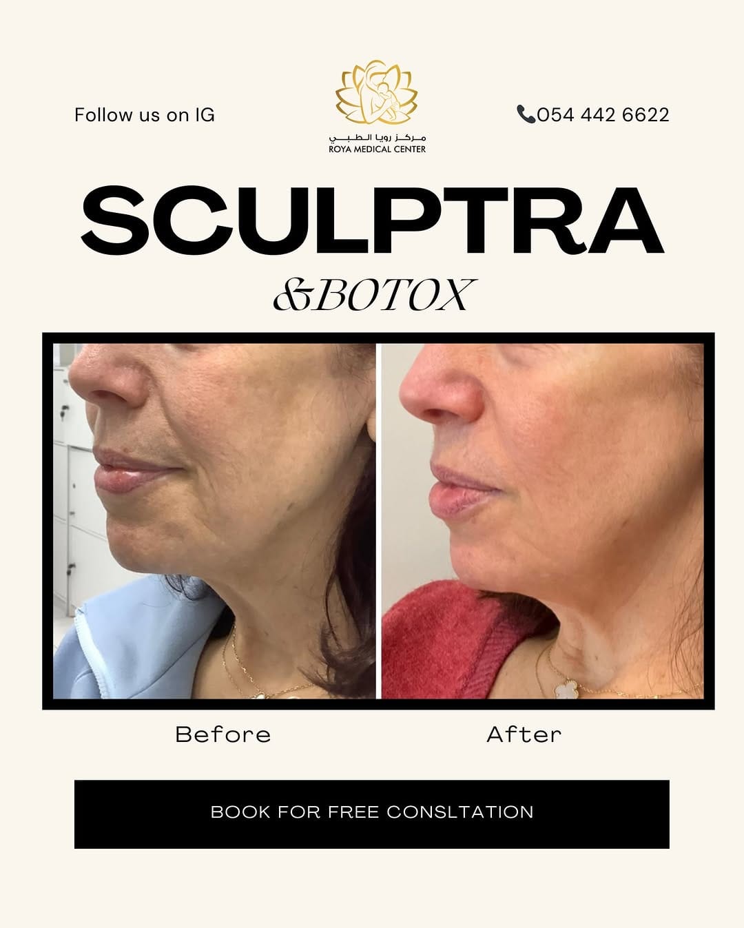 Post 10 by Filler , Botox Pico laser BBL/ Halo Ultraformer Morpheus8 on Instagram (image)