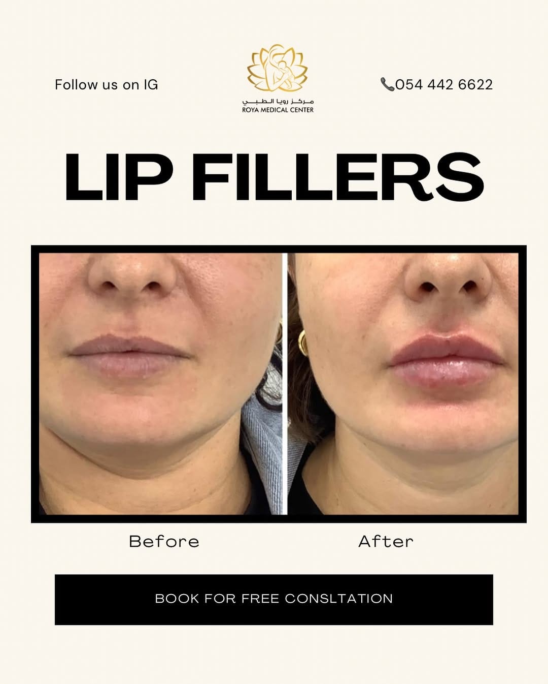Post 8 by Filler , Botox Pico laser BBL/ Halo Ultraformer Morpheus8 on Instagram (image)