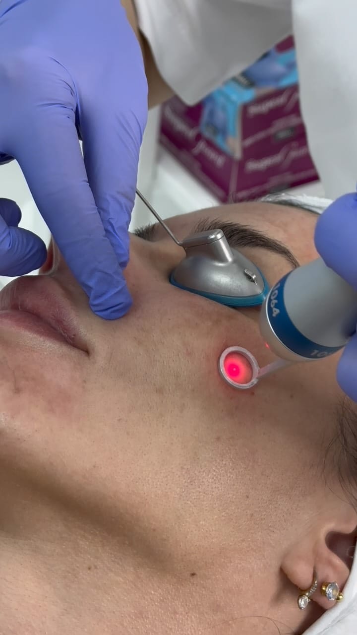 Post 2 by Filler , Botox Pico laser BBL/ Halo Ultraformer Morpheus8 on Instagram (video)