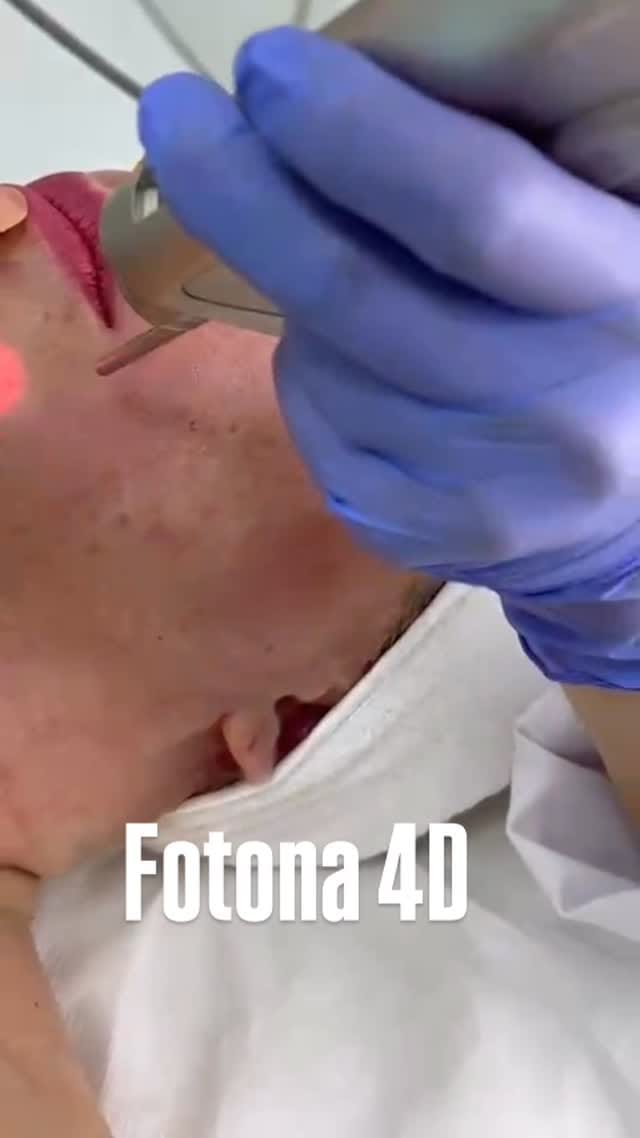 Post 6 by Filler , Botox Pico laser BBL/ Halo Ultraformer Morpheus8 on Instagram (video)