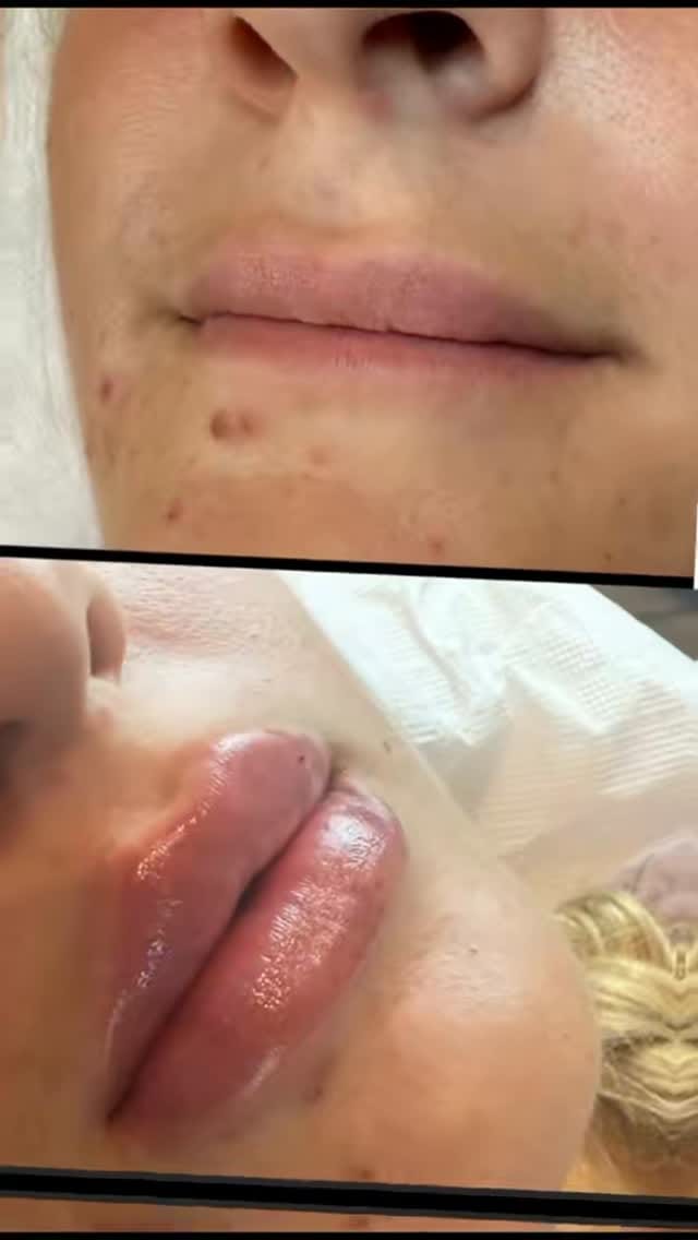 Post 2 by Dr Mahshid Sharif |  Filler Botox on Instagram (video)