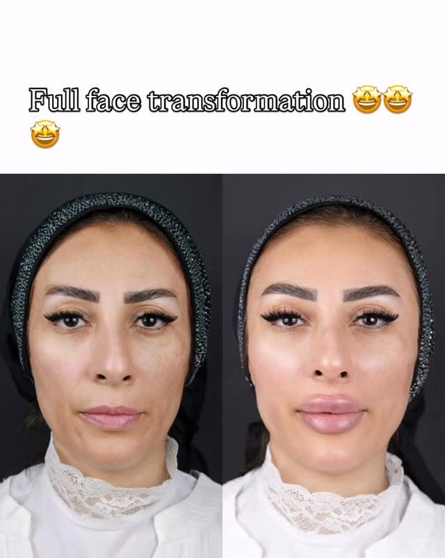 Post 3 by Dr Mahshid Sharif |  Filler Botox on Instagram (video)