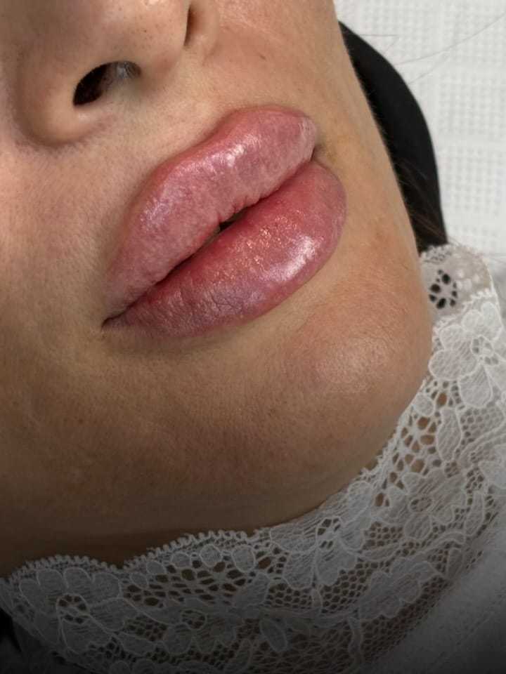 Post 6 by Dr Mahshid Sharif |  Filler Botox on Instagram (carousel)