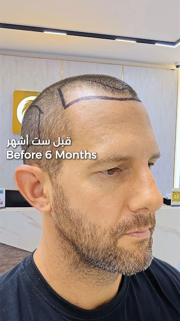 Post 1 by Global Hair Dubai | جلوبال هير دبي on Instagram (video)