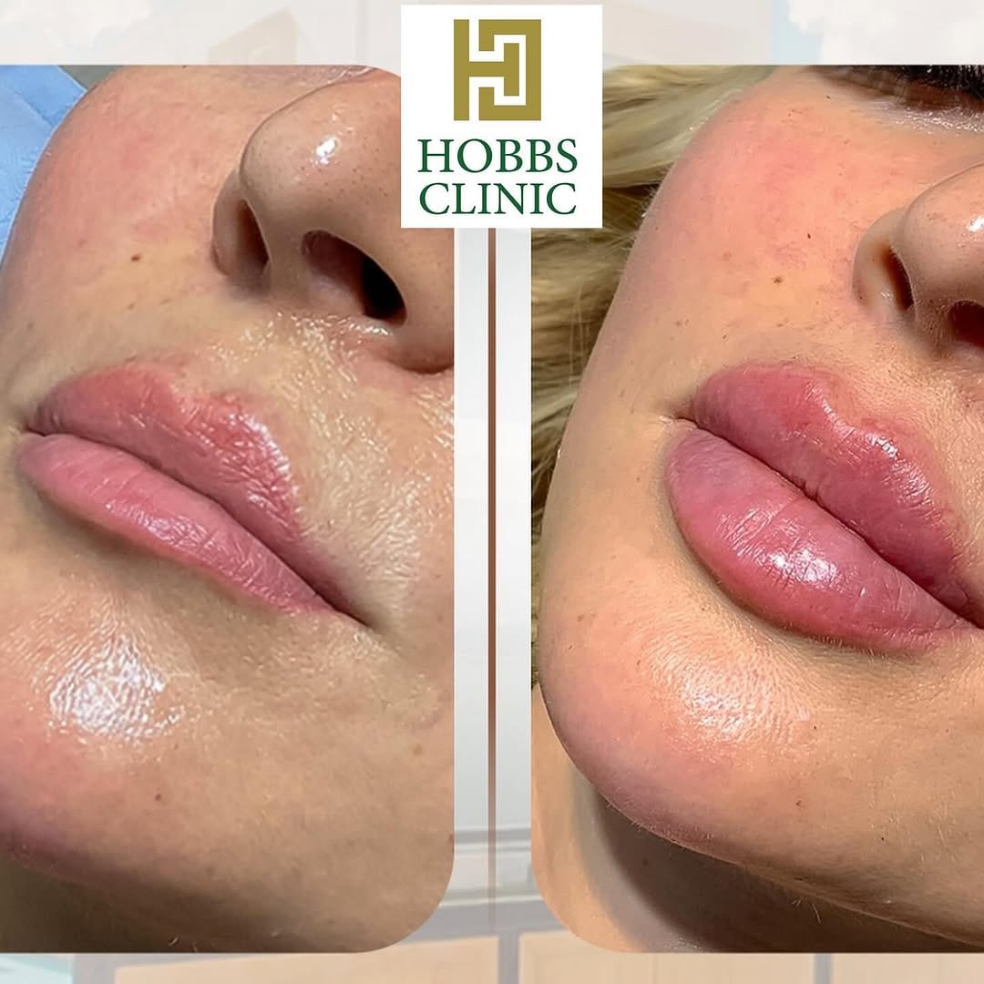 Post 4 by HOBBS Clinic - Dubai on Instagram (image)