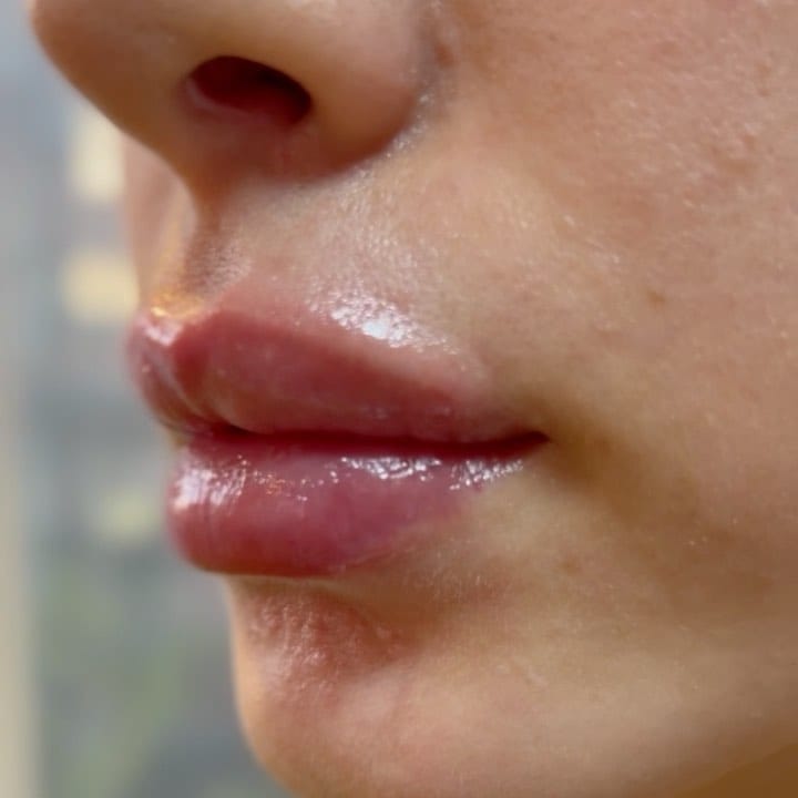 Post 1 by Mehr skin clinic on Instagram (video)