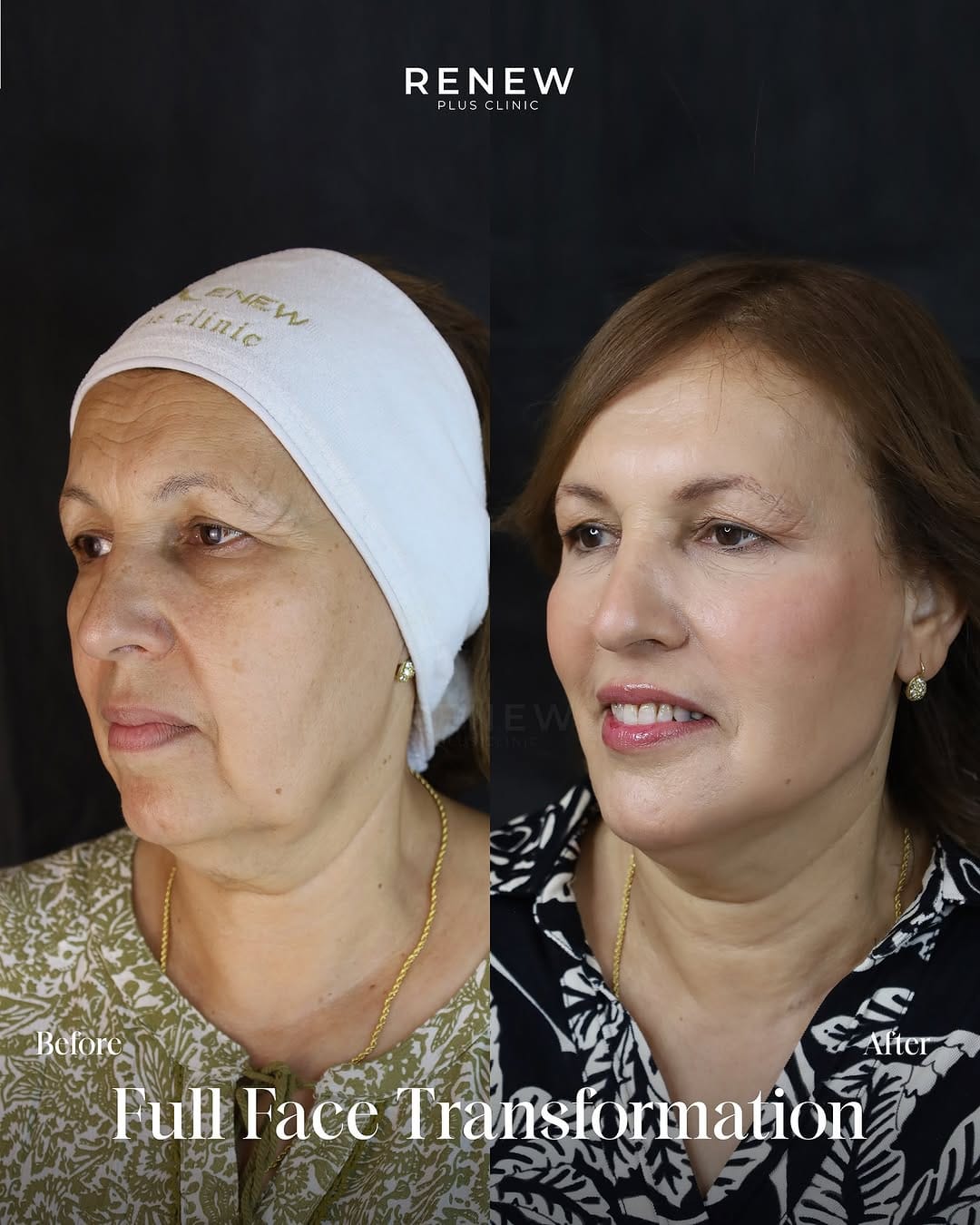 Post 9 by Renew Plus Clinic عيادة رينيو بلس | Dubai on Instagram (carousel)
