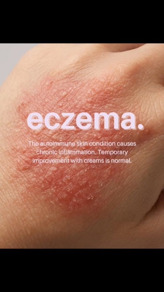 Post 3 by Dr.Emad Arafa,استشاري مناعه وحساسيه,Allergist&Immunologist on Instagram (video)