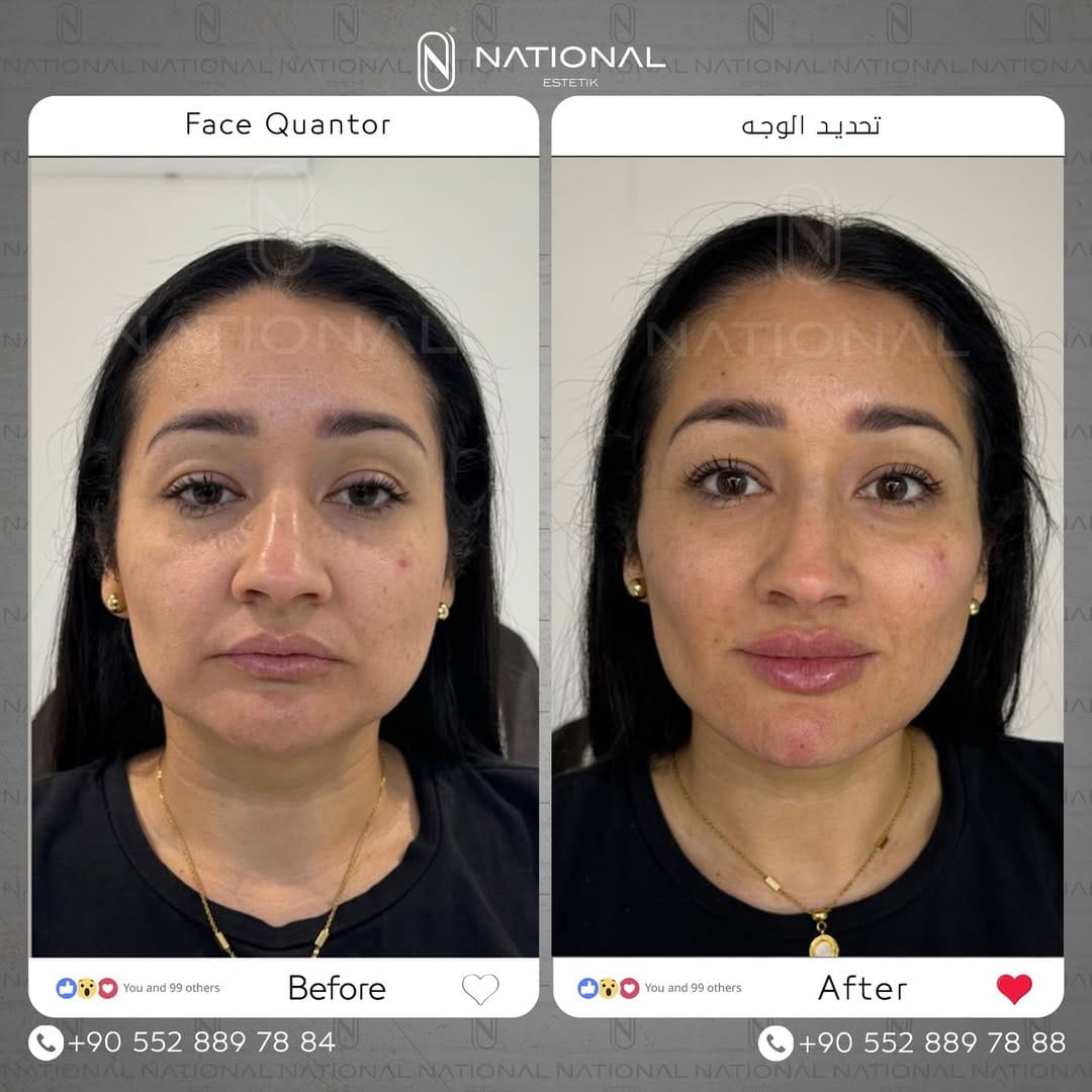 Post 9 by ناشيونال أستاتيك|National Estetik on Instagram (image)