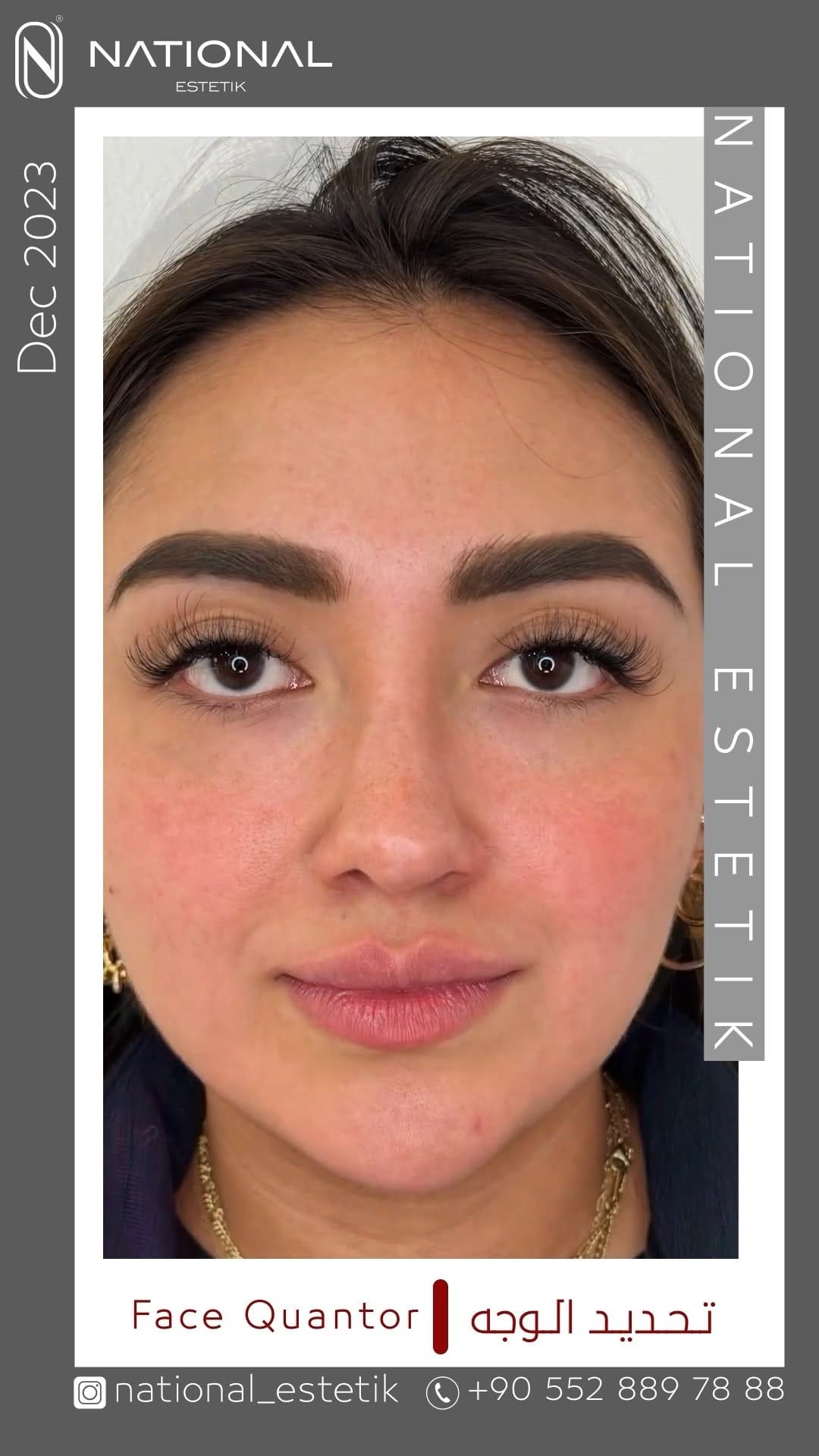 Post 8 by ناشيونال أستاتيك|National Estetik on Instagram (video)