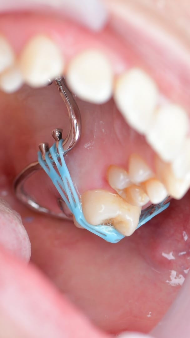 Post 4 by Braces_orthodontist on Instagram (video)