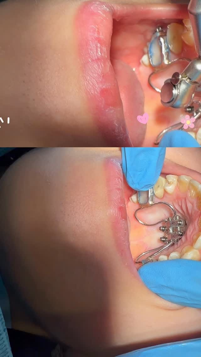 Post 6 by Braces_orthodontist on Instagram (video)