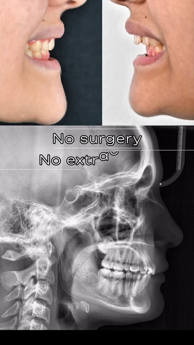 Post 3 by Braces_orthodontist on Instagram (video)