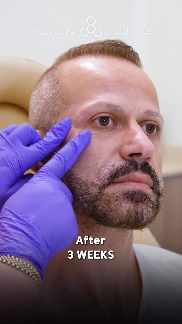 Post 8 by Dr Sima - BOTOX/LIP/FILLER/Endolift/Dubai on Instagram (video)